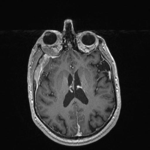 Atypical meningioma (grade II) - en plaque (Radiopaedia 29633-30147 Axial T1 C+ 110).jpg