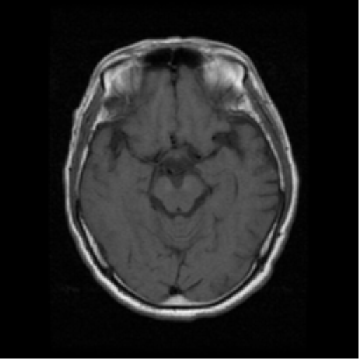 File:Atypical meningioma with skull invasion (Radiopaedia 34357-35648 Axial T1 9).png