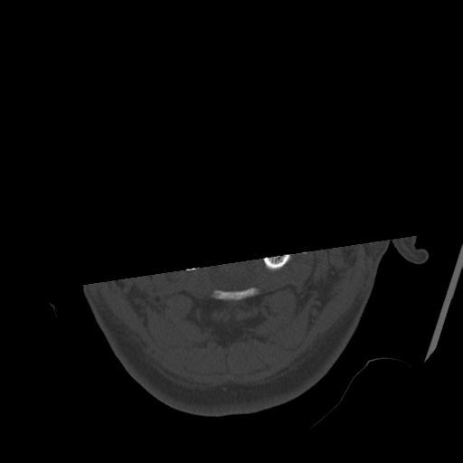 File:Atypical meningioma with skull invasion (Radiopaedia 34357-35649 Axial bone window 4).png