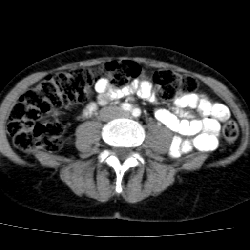 File:Atypical renal cyst (Radiopaedia 17536-17251 renal cortical phase 30).jpg