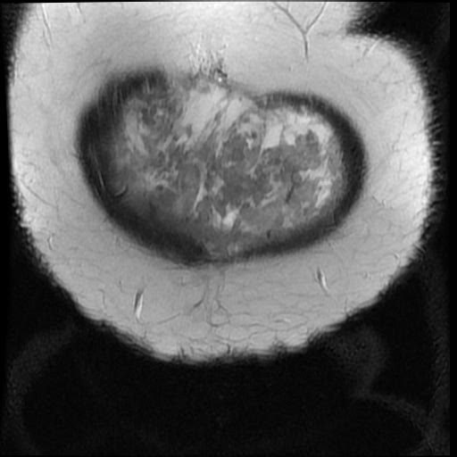 File:Atypical retroperitoneal lymphocoeles with large leiomyoma of uterus (Radiopaedia 32084-33027 Coronal T2 2).jpg