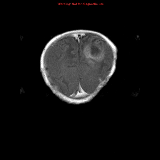 File:Atypical teratoid rhabdoid tumor (Radiopaedia 10712-11183 Coronal T1 C+ 2).jpg