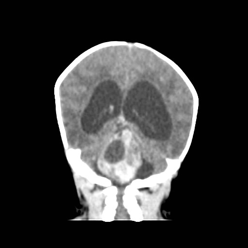 File:Atypical teratoid rhabdoid tumor (prenatal US and neonatal MRI) (Radiopaedia 59091-66387 Coronal non-contrast 1).jpg