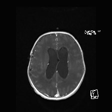 Atypical teratoid rhabdoid tumor (prenatal US and neonatal MRI) (Radiopaedia 59091-66388 Axial T1 C+ 41).jpg