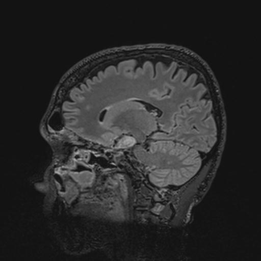 Autoimmune limbic encephalitis (Radiopaedia 30363-31005 Sagittal FLAIR 95).jpg