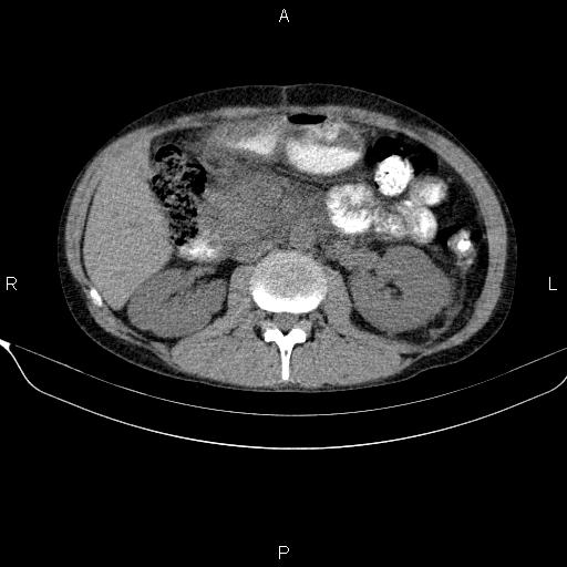 Autoimmune pancreatitis (Radiopaedia 84925-100431 Axial non-contrast 25).jpg