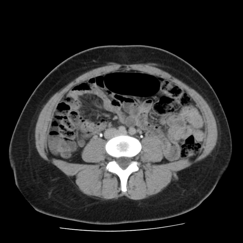 Autosomal dominant polycystic kidney disease (Radiopaedia 23061-23093 C+ delayed 44).jpg