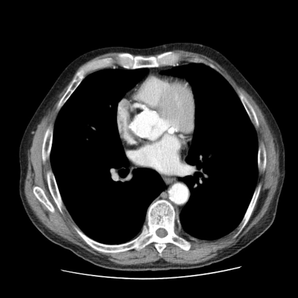 Autosomal dominant polycystic kidney disease (Radiopaedia 27851-28094 B 34).jpg
