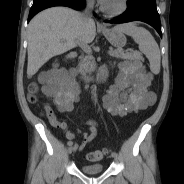 File:Autosomal dominant polycystic kidney disease (Radiopaedia 36539-38101 C 33).jpg