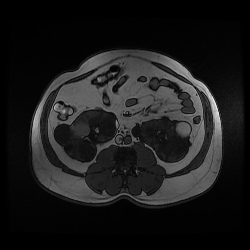 Autosomal dominant polycystic kidney disease (Radiopaedia 50259-55611 Axial 2D Dual Echo 55).jpg
