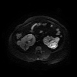 Autosomal dominant polycystic kidney disease (Radiopaedia 50259-55611 Axial DWI 65).jpg