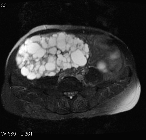 File:Autosomal dominant polycystic kidney disease (Radiopaedia 5202-6969 Axial T2 fat sat 14).jpg