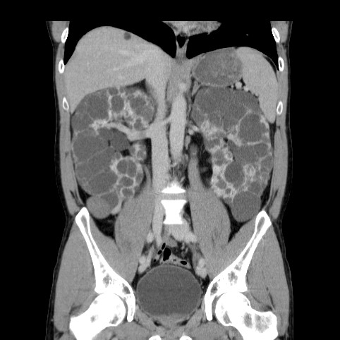 Autosomal dominant polycystic kidney disease (Radiopaedia 66349-75582 A 45).jpg