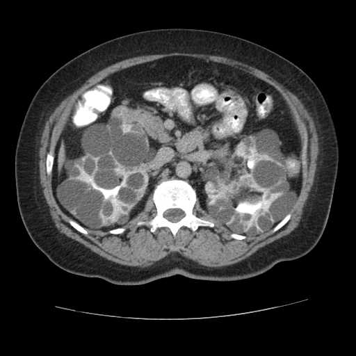 Autosomal dominant polycystic kidney disease with hepatic involvement (Radiopaedia 32693-33662 C 31).jpg