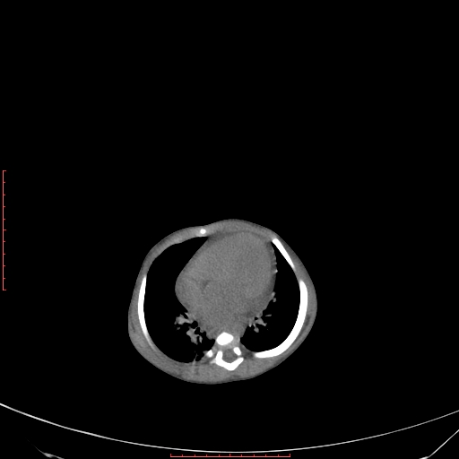 Autosomal recessive polycystic kidney disease associated with Caroli disease (Radiopaedia 61932-69984 Axial non-contrast 71).jpg