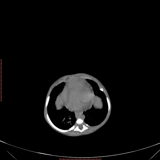 Autosomal recessive polycystic kidney disease associated with Caroli disease (Radiopaedia 61932-69984 Axial non-contrast 94).jpg
