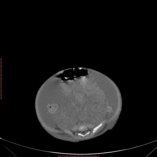Autosomal recessive polycystic kidney disease associated with Caroli disease (Radiopaedia 61932-69984 B 263).jpg