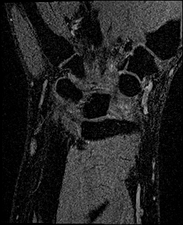 Avascular necrosis of the capitate (Radiopaedia 88317-104948 Coronal T1 vibe 51).jpg