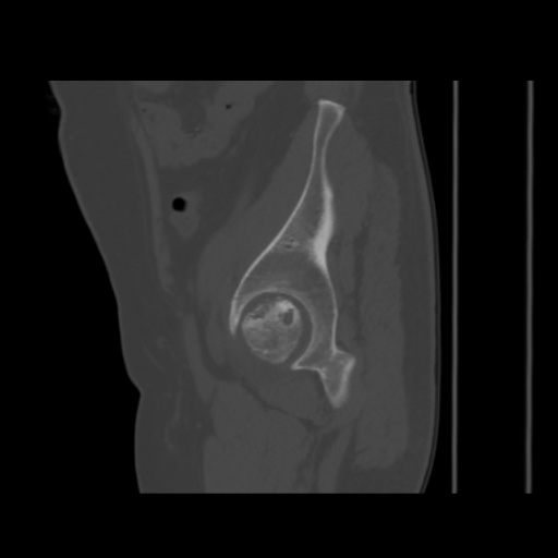 Avascular necrosis of the hip (Radiopaedia 61503-69467 B 45).jpg