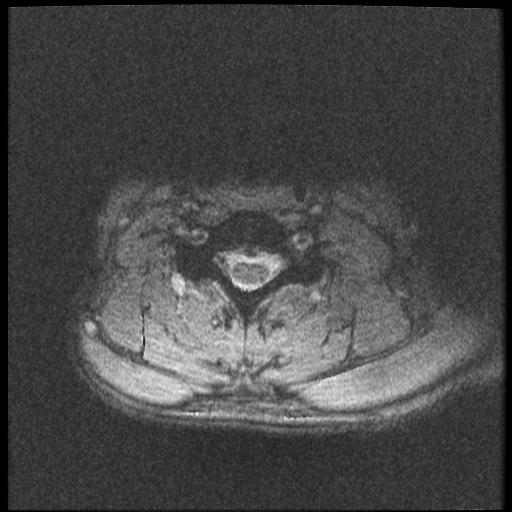 File:Axis fracture - MRI (Radiopaedia 71925-82375 Axial T2 fat sat 16).jpg