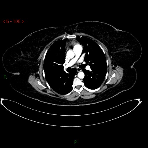 File:Azygos fissure and lobe (Radiopaedia 47620-52278 A 91).jpg