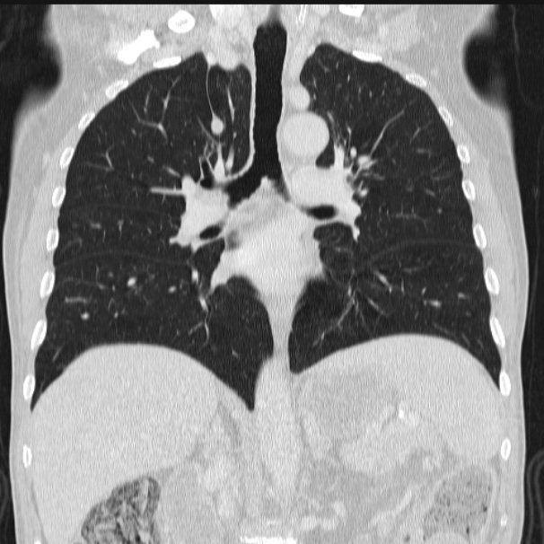 Azygos lobe (Radiopaedia 38259-40275 Coronal lung window 44).jpg