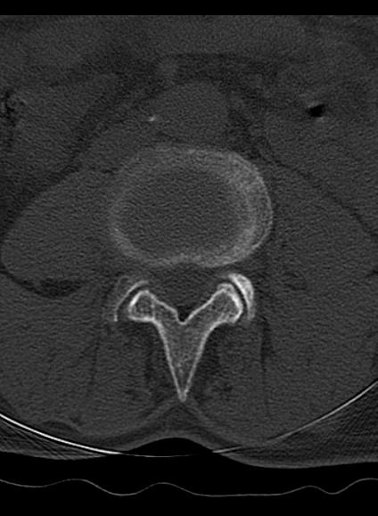 File:Baastrup syndrome (Radiopaedia 64891-73838 Axial bone window 2).jpg