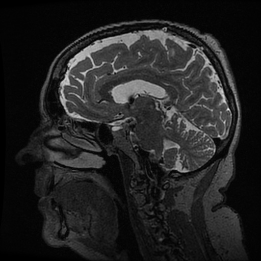 Balo concentric sclerosis (Radiopaedia 53875-59982 Sagittal 3D FSE 130).jpg