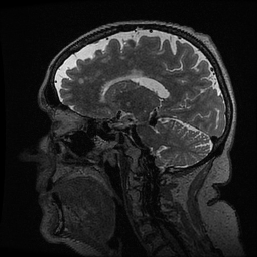 Balo concentric sclerosis (Radiopaedia 53875-59982 Sagittal 3D FSE 169).jpg