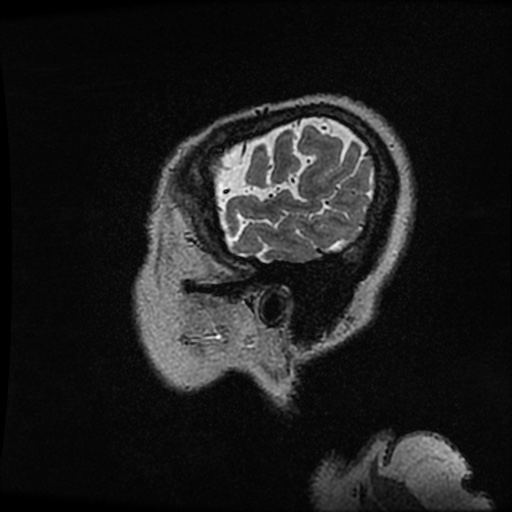 Balo concentric sclerosis (Radiopaedia 53875-59982 Sagittal 3D FSE 266).jpg