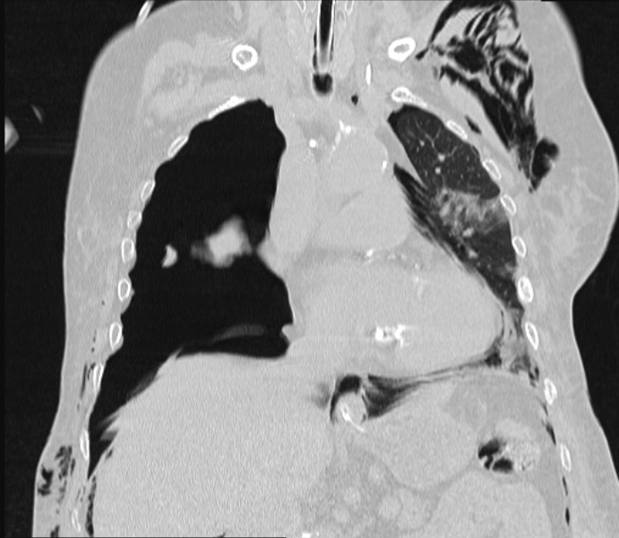 Barotrauma due to mechanical ventilation (Radiopaedia 28079-28336 Coronal lung window 46).jpg