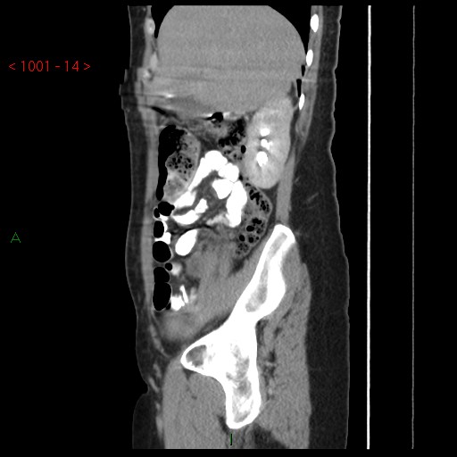 File:Bartholin gland cyst (Radiopaedia 54904-61181 Sagittal C+ delayed 14).jpg
