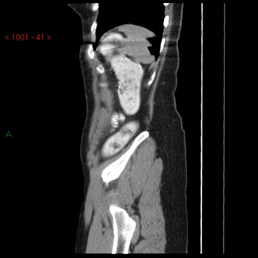 File:Bartholin gland cyst (Radiopaedia 54904-61181 Sagittal C+ delayed 41).jpg
