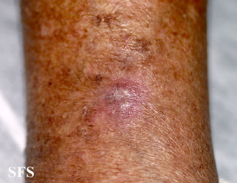 Basal Cell Carcinoma (Dermatology Atlas 140).jpg