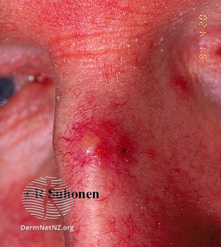 File:Basal cell carcinoma affecting the nose (DermNet NZ lesions-bcc-nose-0618).jpg