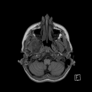 Base of skull rhabdomyosarcoma (Radiopaedia 32196-33142 Axial T1 6).jpg