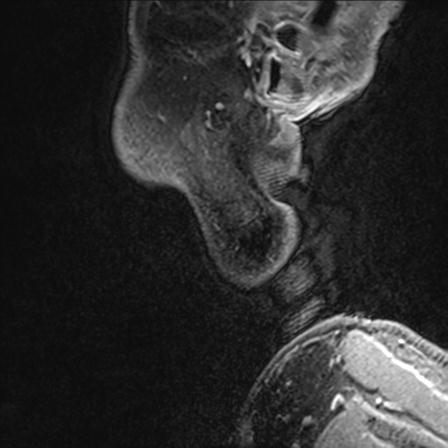 Base of tongue squamous cell carcinoma (Radiopaedia 31174-31884 F 172).jpg