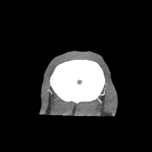 Basilar and bilateral vertebral artery occlusion (Radiopaedia 45592-49723 B 98).png