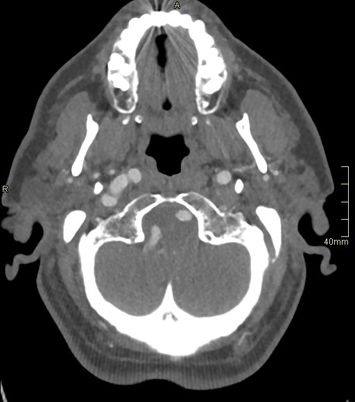 Basilar artery aneurysm (Radiopaedia 56261-62932 A 37).jpg