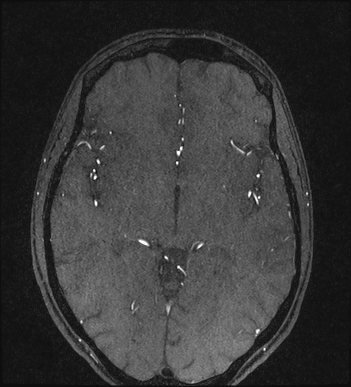 Basilar artery perforator aneurysm (Radiopaedia 82455-97733 Axial MRA 127).jpg