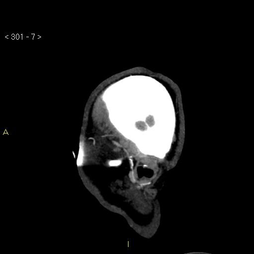 Basilar artery thrombosis (Radiopaedia 16260-15944 C 1).jpg