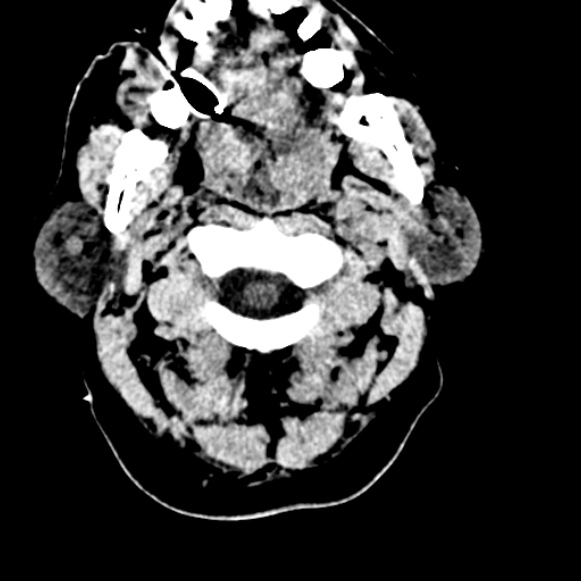 Basilar artery thrombosis (Radiopaedia 53351-59333 Axial non-contrast 9).jpg