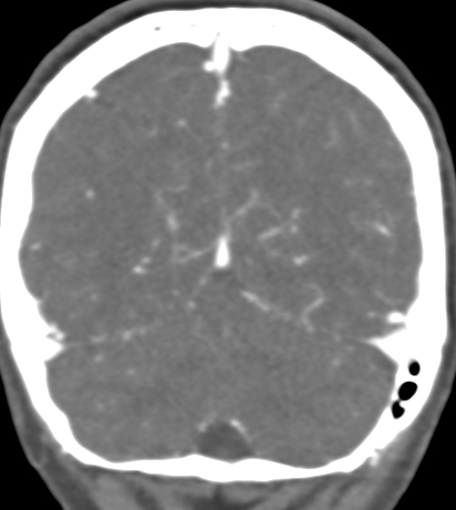 Basilar tip aneurysm with coiling (Radiopaedia 53912-60086 B 124).jpg
