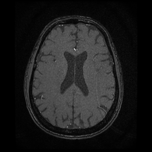 Basilar top and left middle cerebral artery aneurysm (Radiopaedia 61965-70031 Axial MRA 109).jpg