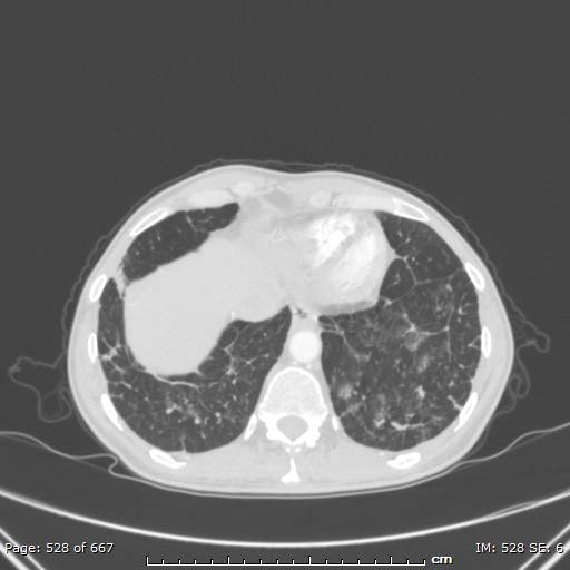 File:Behçet disease (Radiopaedia 44247-47889 Axial lung window 73).jpg