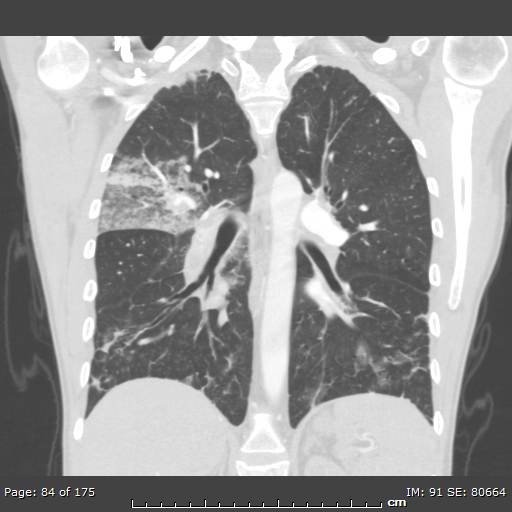 Behçet disease (Radiopaedia 44247-47889 Coronal lung window 24).jpg