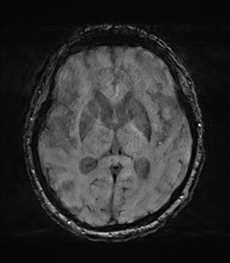 Behavioral variant frontotemporal dementia and late onset schizophrenia (Radiopaedia 52197-58083 Axial SWI 38).png