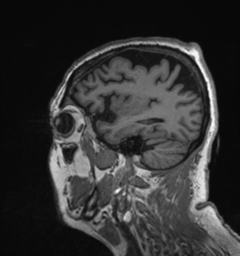 Behavioral variant frontotemporal dementia and late onset schizophrenia (Radiopaedia 52197-58083 Sagittal T1 82).png