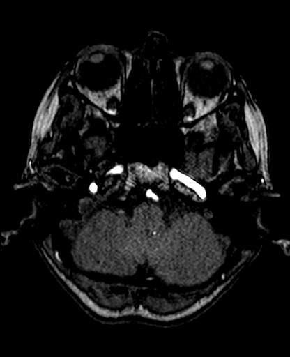 File:Berry aneurysm of the terminal internal carotid artery (Radiopaedia 88286-104918 Axial TOF 64).jpg