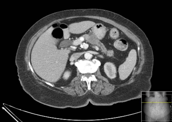 Bicameral celiacomesenteric aneurysm (Radiopaedia 55766-62327 A 21).jpg